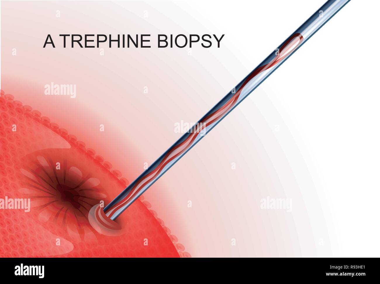 Vector Illustration eines trephine Biopsie von Krebstumoren Stock Vektor