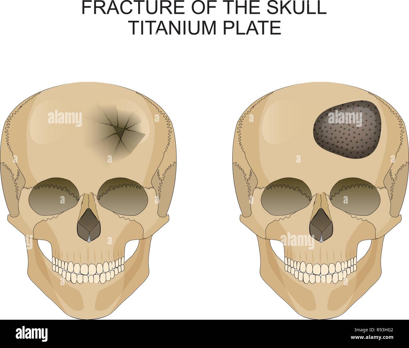 Vector Illustration von traumatischen Hirnverletzungen. Titan Platte Stock Vektor