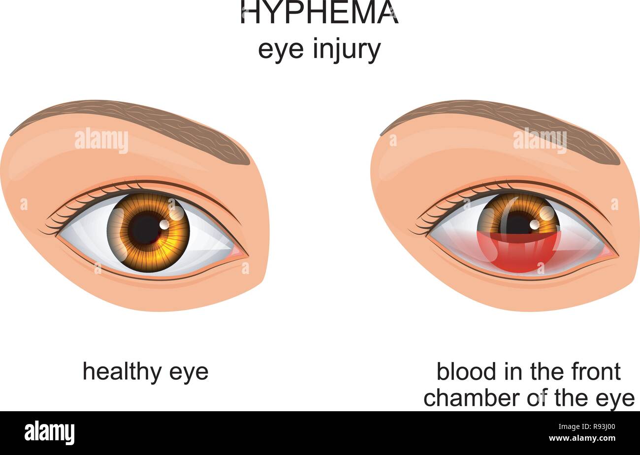 Vector Illustration der Auge Verletzung des Auges. hyphema. Stock Vektor