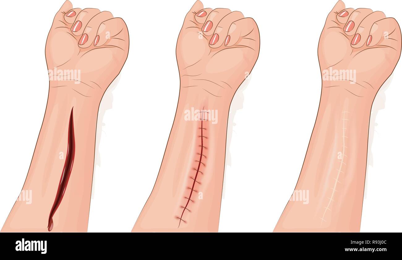 Vector Abbildung: genähte Wunde Hände. Chirurgie Stock Vektor