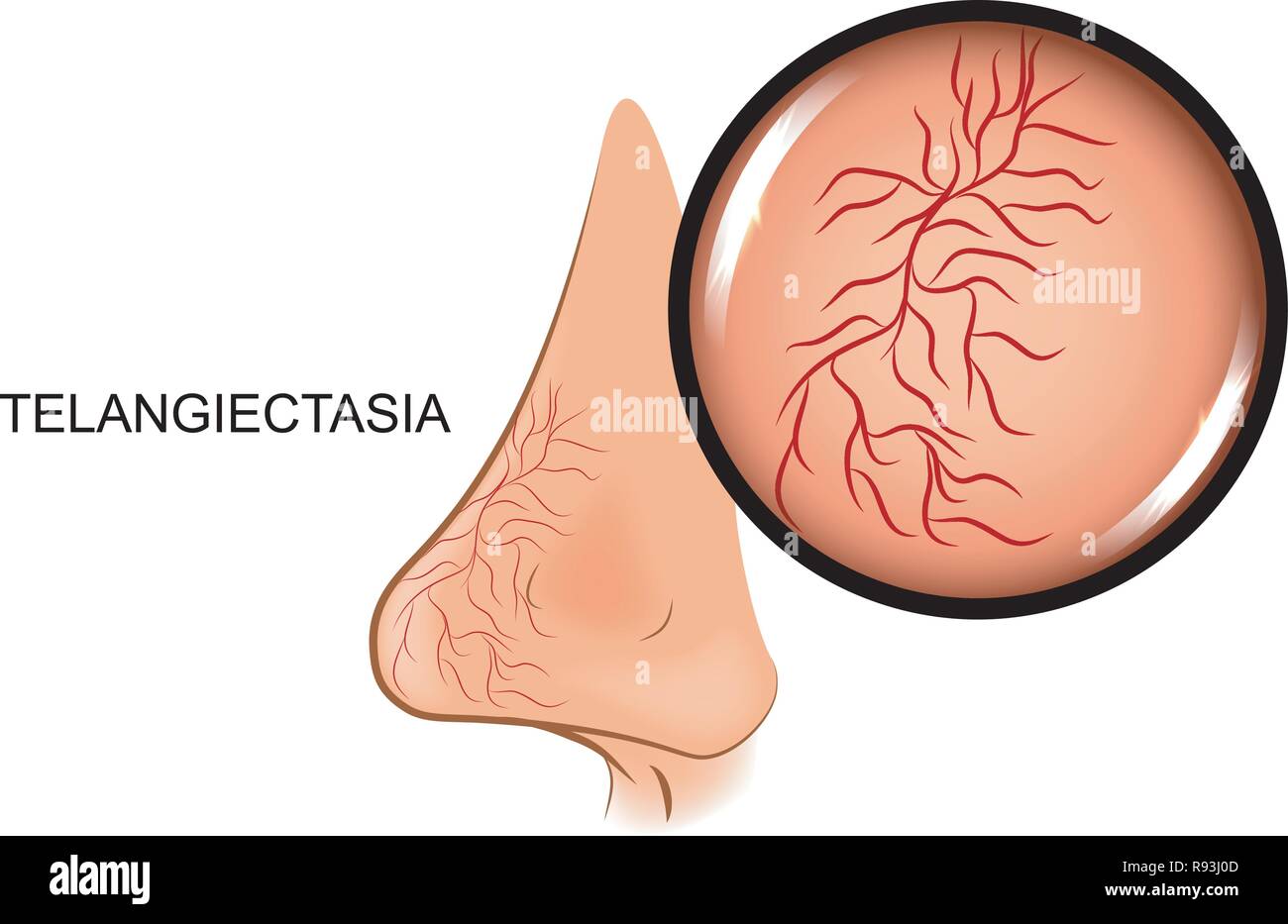 Vector Illustration der Erweiterung der Blutgefäße in der Nase. Teleangiektasien, Stock Vektor