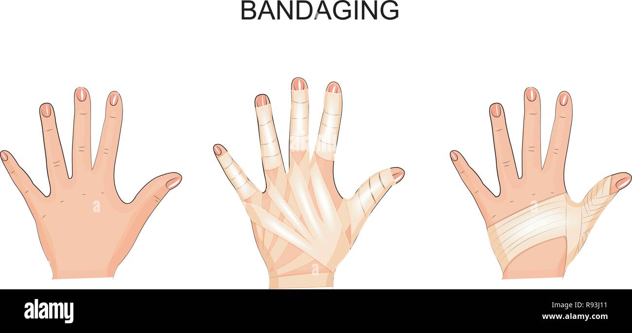 Vector Illustration der Bandagierung seine Hände. Chirurgie Stock Vektor
