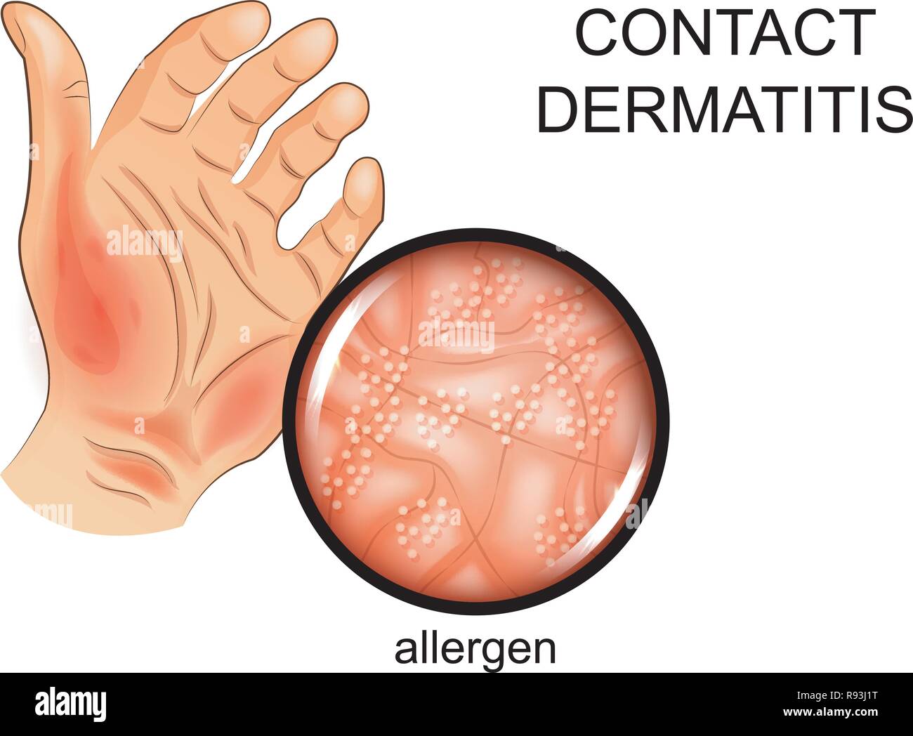 Vector Illustration eines Allergens auf die Haut. Allergie, Dermatologie Stock Vektor