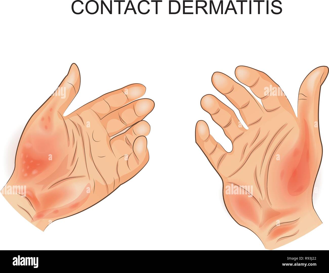 Vector Illustration einer Kontaktdermatitis. Allergie, Dermatologie. Stock Vektor