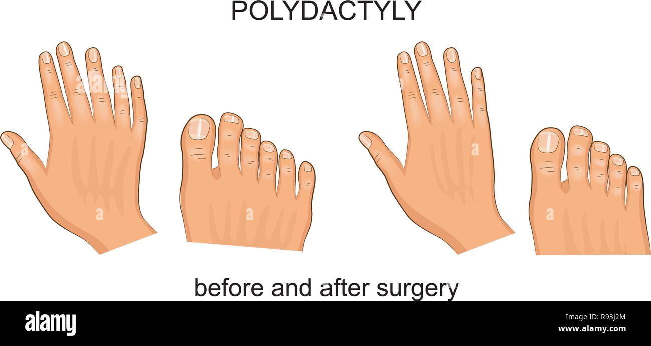 Vector Illustration der polydaktylie vor und nach der Operation. Stock Vektor