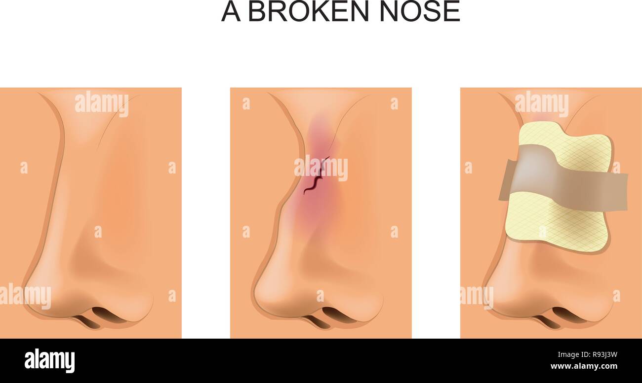 Vector Illustration einer gebrochenen Nase, verband Stock Vektor