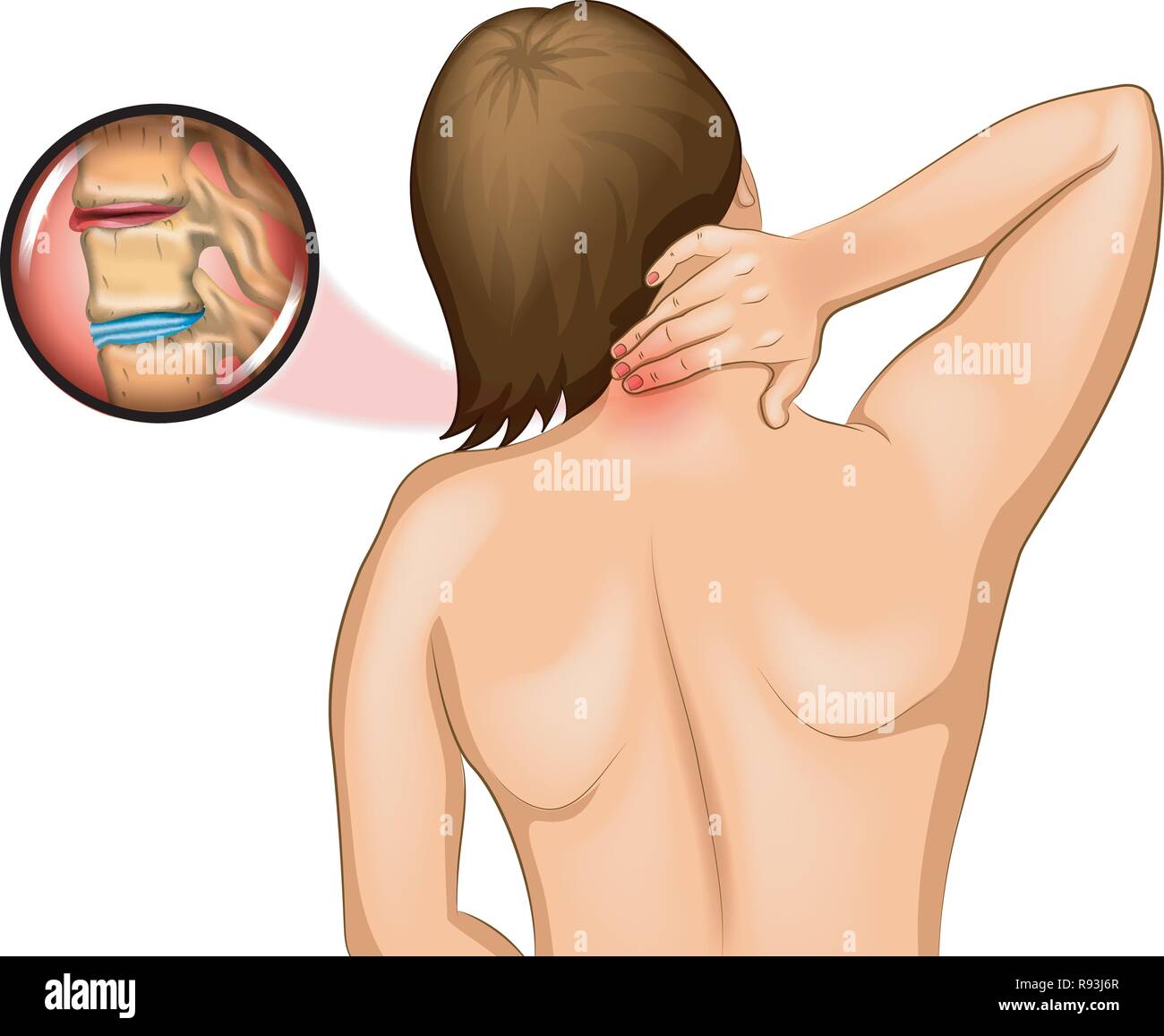 Vector Illustration von Schmerzen in der Halswirbelsäule Stock Vektor