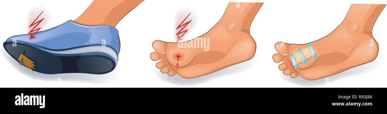 Vector Illustration von Trauma zu den Fuß. den Nagel in den Fuß Stock Vektor