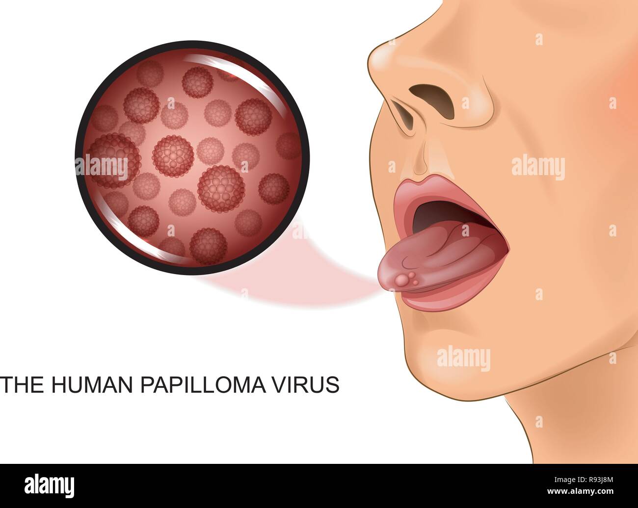 Vector Illustration des menschlichen papillomavirus auf der Zunge Stock Vektor