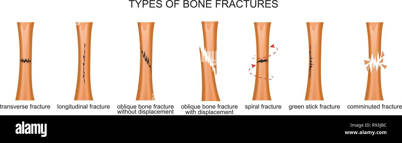Vector Illustration der Arten von Knochenbrüchen Stock Vektor