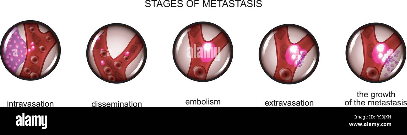 Vector Illustration der Stufe der Metastasierung von Krebszellen Stock Vektor