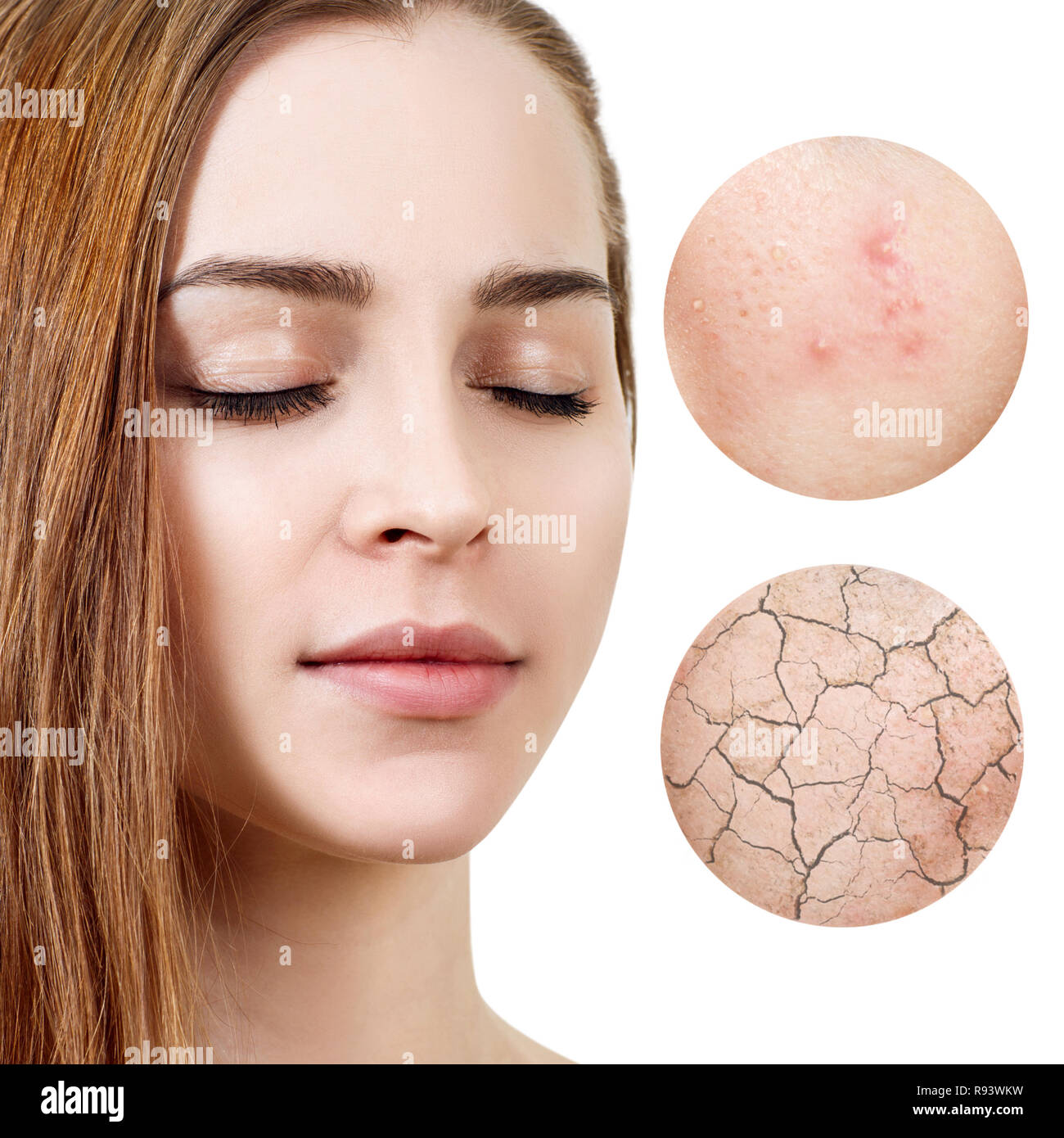 Zoom Kreise zeigt Problem Haut der jungen Frau. Stockfoto