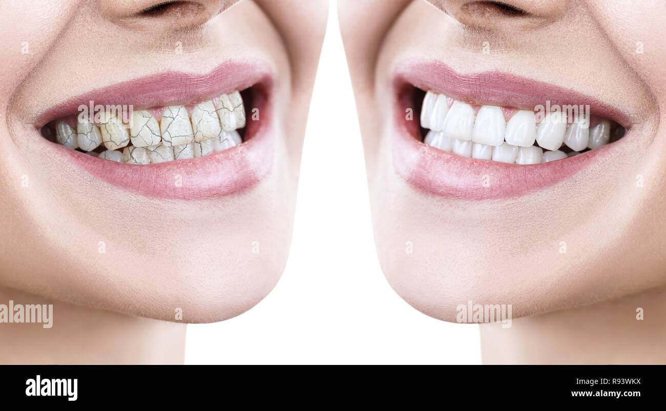 Zähne der jungen Frau vor und nach der Behandlung. Stockfoto