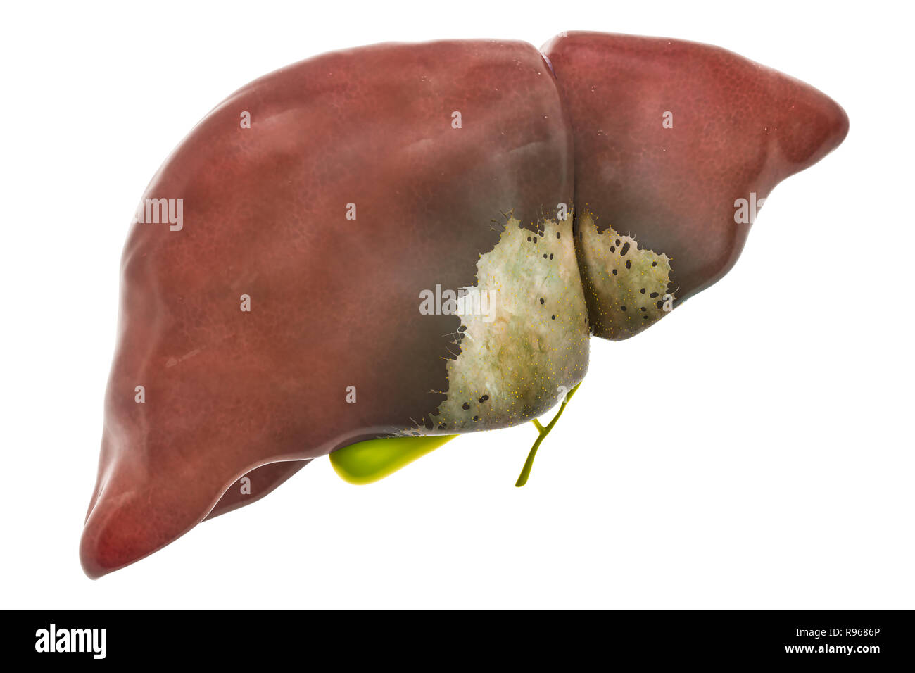 Leber- oder Erkrankung der Gallenblase Konzept, 3D-Rendering auf weißem Hintergrund Stockfoto