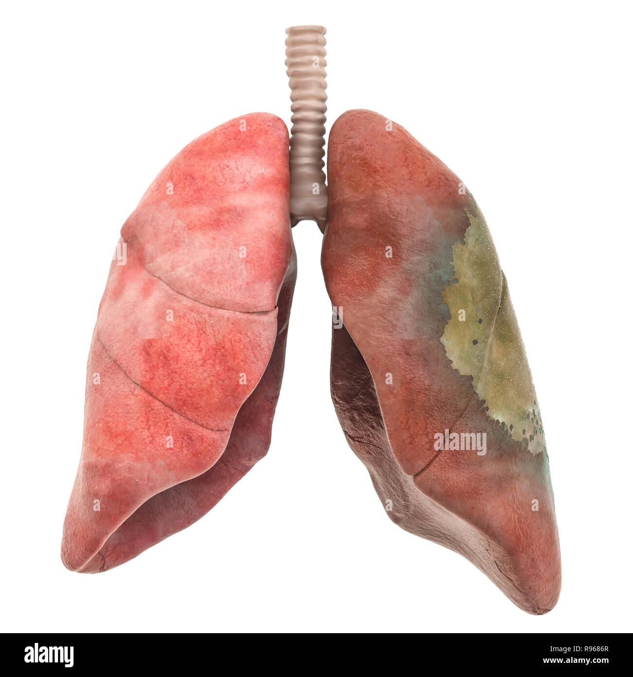 Lungen Krankheit, Infektion Konzept, 3D-Rendering auf weißem Hintergrund Stockfoto