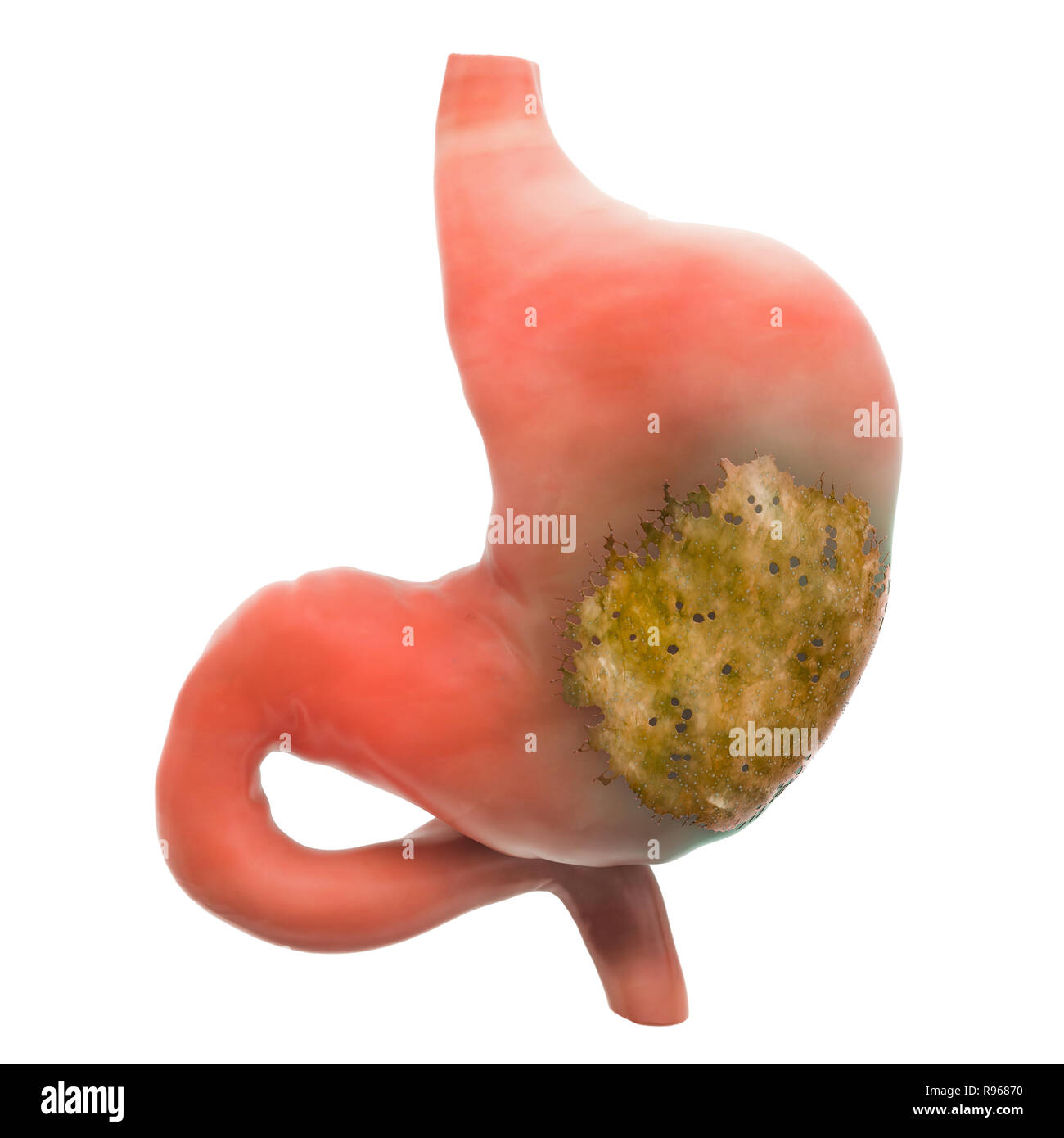 Magen Krankheit Konzept, 3D-Rendering auf weißem Hintergrund Stockfoto