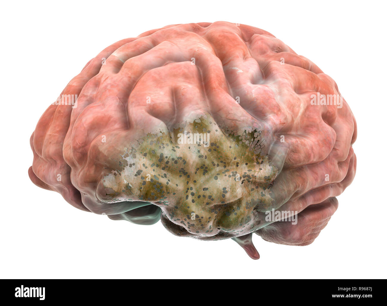 Erkrankung des Gehirns. 3D-Rendering auf weißem Hintergrund Stockfoto