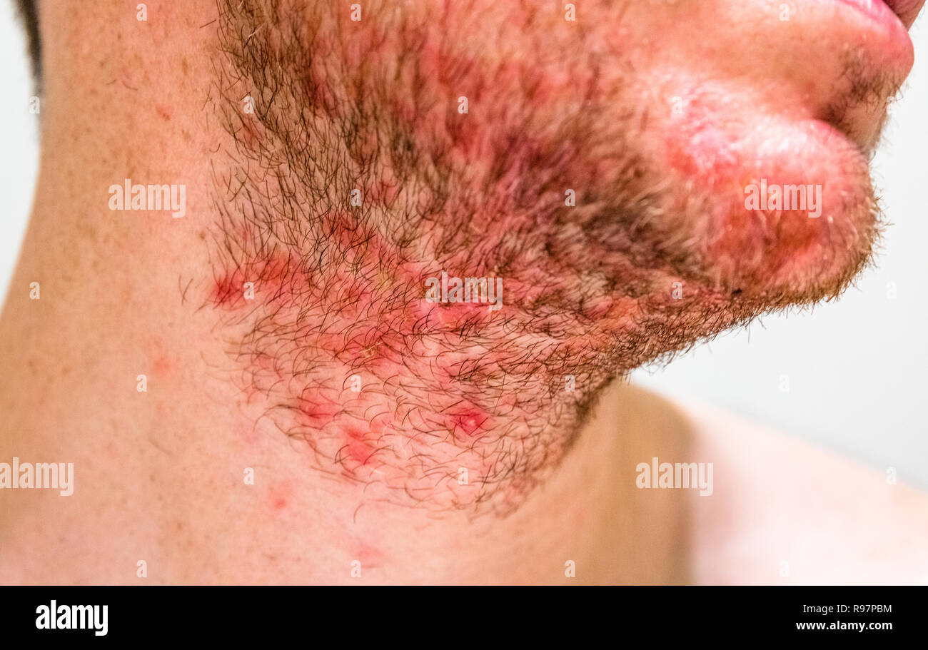 Mann mit seborrhoische Dermatitis in den Bart Bereich Stockfotografie Alamy