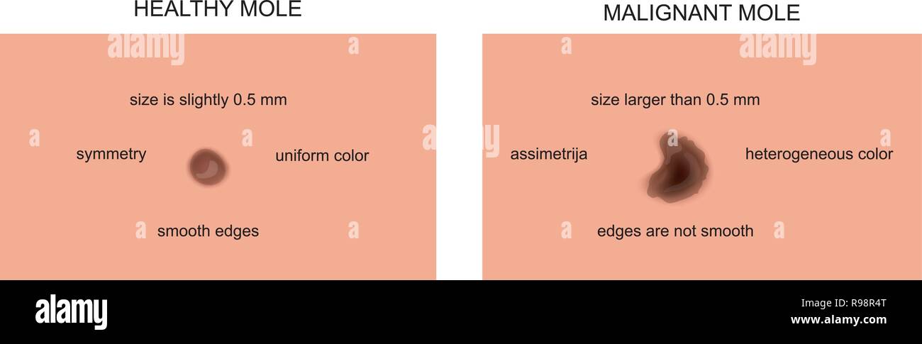 Vector Abbildung: Anzeichen für einen bösartigen Mole Stock Vektor