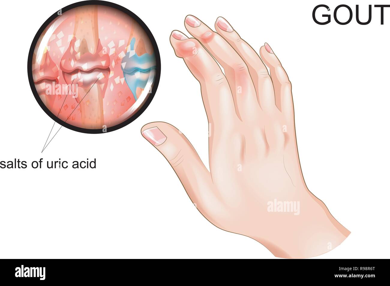 Vector Illustration der Gicht, Arthrose der Finger Stock Vektor