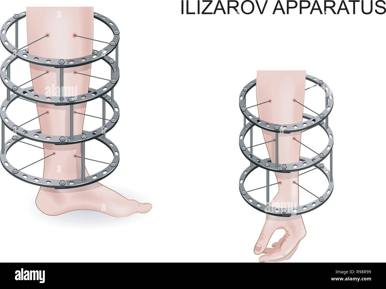 Vector Illustration der Ilizarov Apparate für die Behandlung von Frakturen Stock Vektor