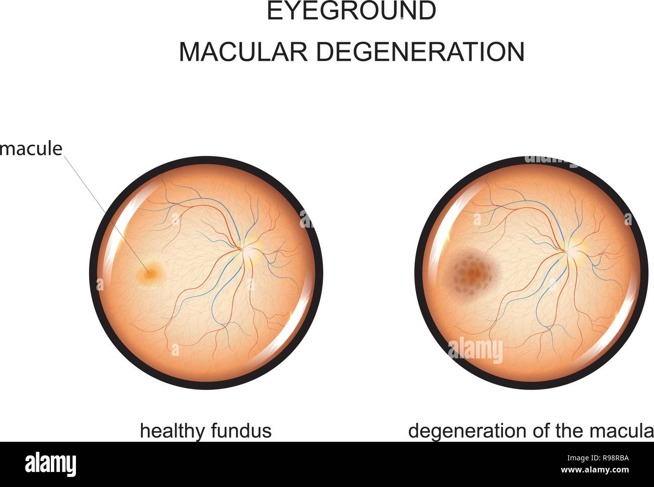 Vector Illustration des Augenhintergrunds. Degeneration der Makula Stock Vektor