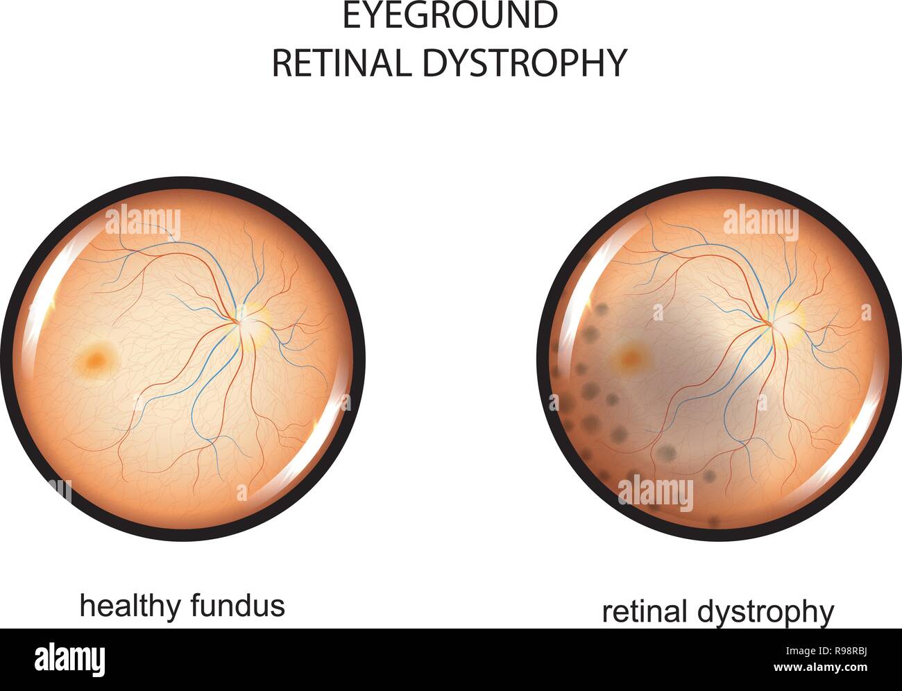 Vector Illustration des Augenhintergrunds. retinal Dystrophie Stock Vektor