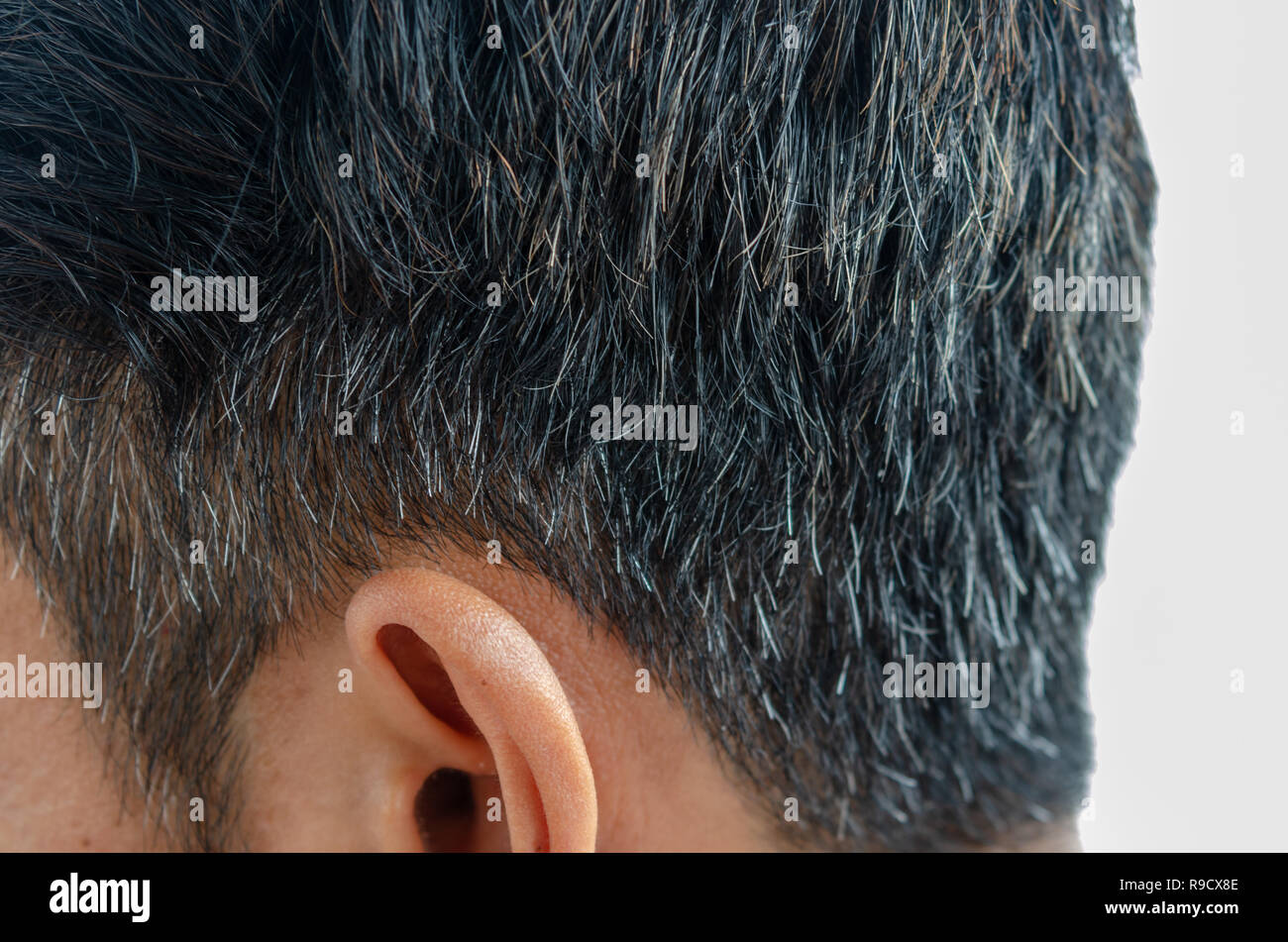 Weiße Haare verliert Haare in einem jungen Mann. Stockfoto