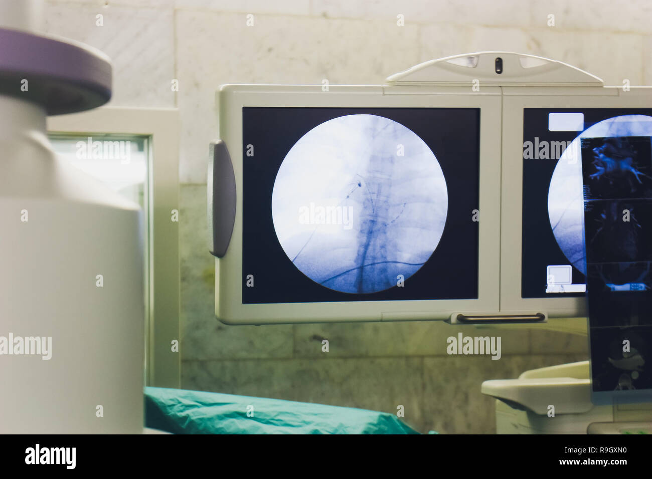 Discus Hernia diagnostiziert, Chirurgie, Rückenmark überwachen Stockfoto