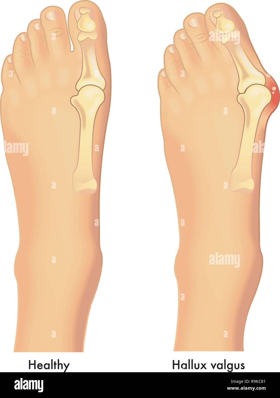 Eine medizinische Illustration eines gesunden Fuß und ein Fuß mit einem ballenzeh oder einer Hallux valgus auf das Gemeinsame der großen Zehe. Stock Vektor