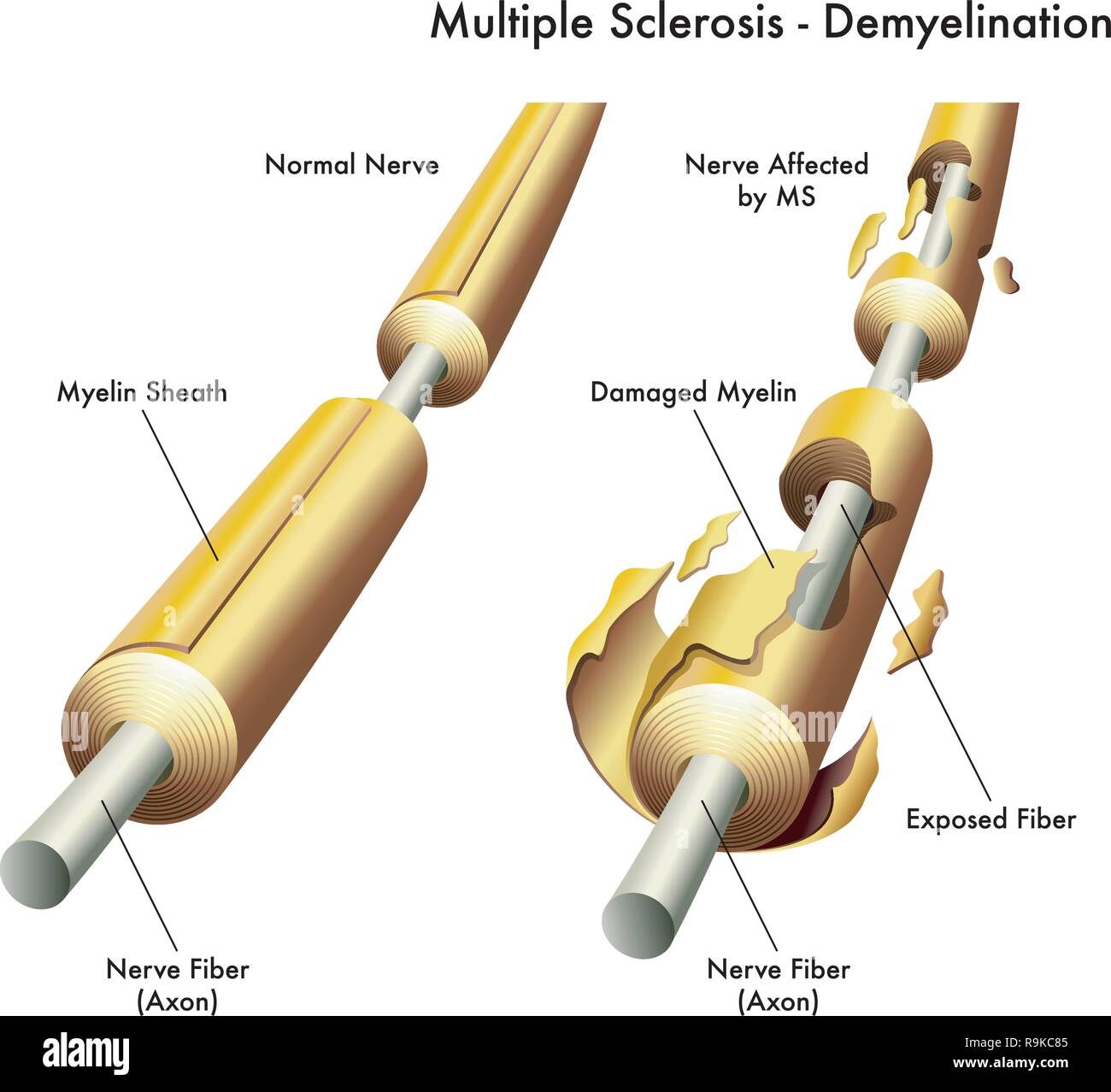 3d-medizinischen Abbildung vergleichen von gesunden Nervenzellen mit der Bezeichnung eines mit Schäden, die durch Multiple Sklerose verursacht. Stock Vektor