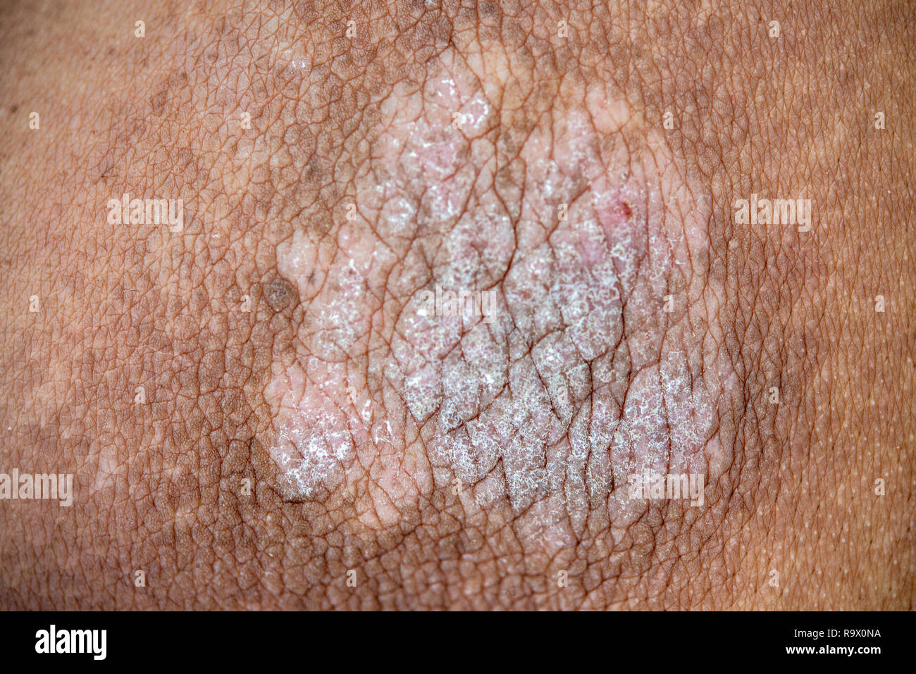 Psoriasis auf Mann haut, aus der Nähe. Stockfoto