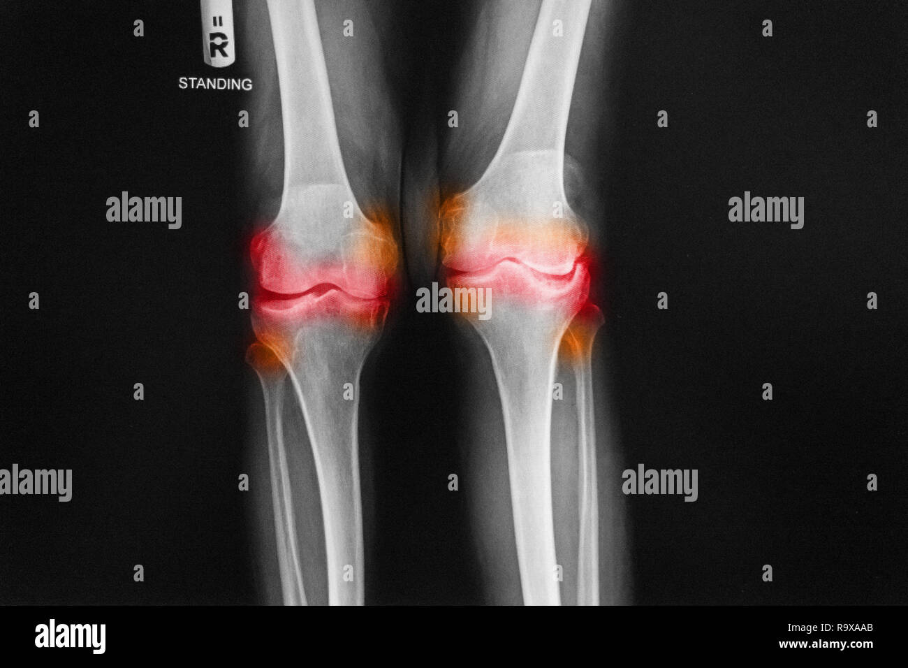 Arthrose rechtes Knie film x-ray-AP (anterior-posterior) von Knie zeigen engen gemeinsamen Raum. Stockfoto