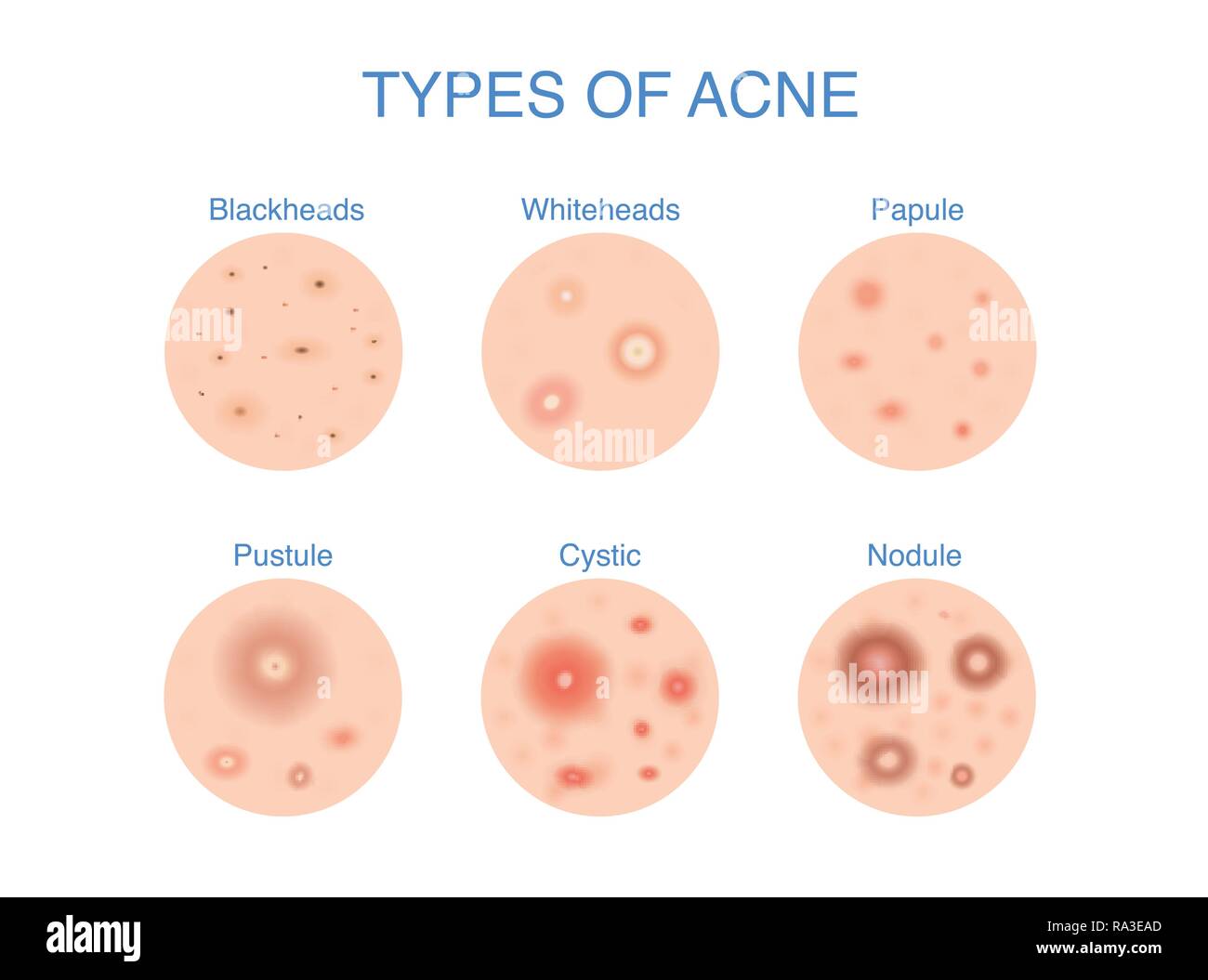 Arten von Akne Symbol für Hautprobleme Inhalt. Stock Vektor
