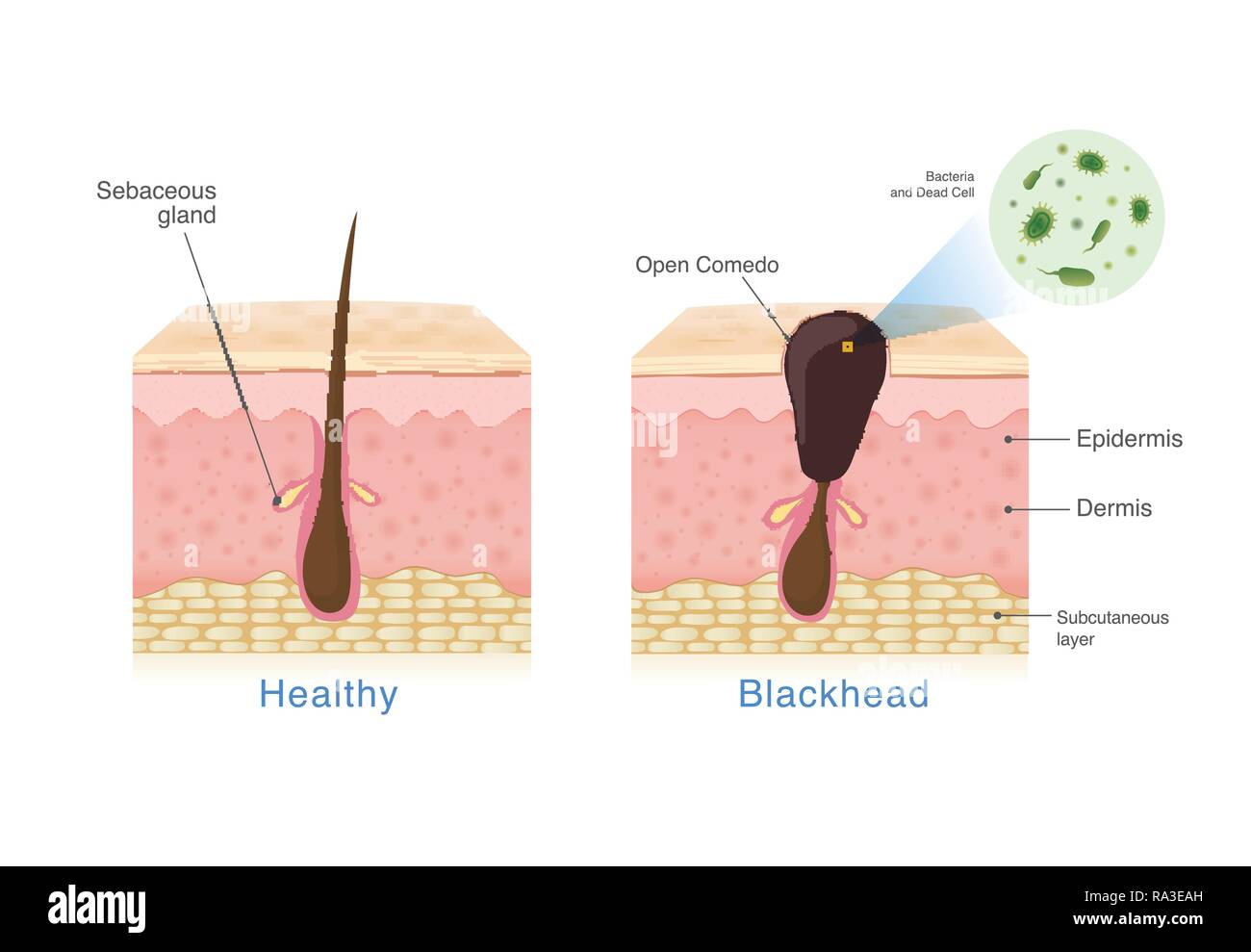Bakterien in blackhead mit menschlicher Haut Schicht Struktur und gesunde Haut. Stock Vektor