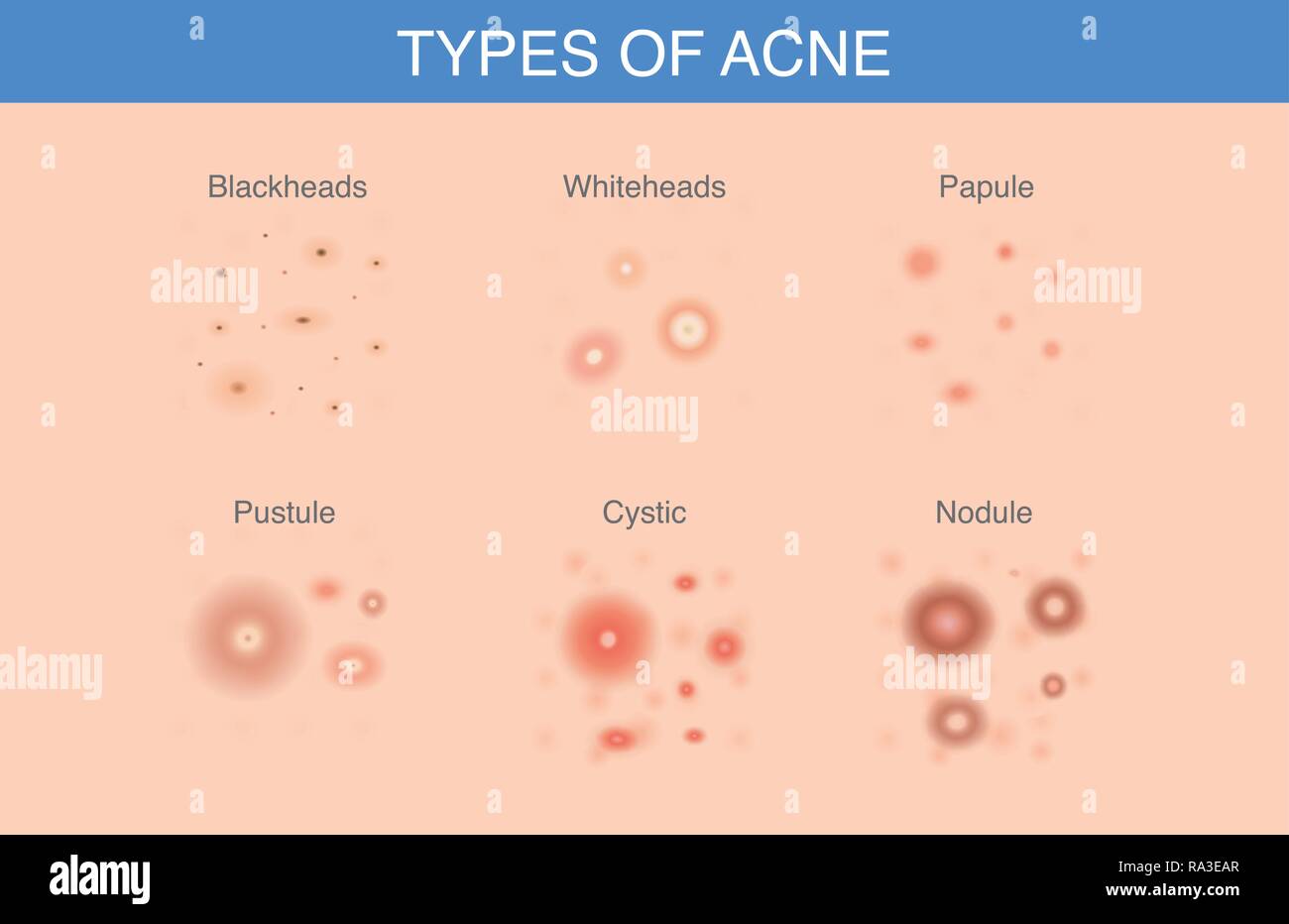 Alle Arten von Akne erscheinen auf der Oberfläche der Haut. Stock Vektor