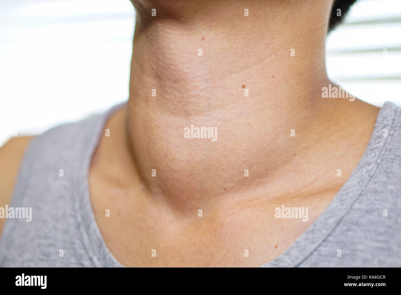 Asiatische Dame Frau Patienten abnorme Vergrößerung der Schilddrüse Hyperthyreose (Überfunktion der Schilddrüse) an der Kehle: Gesunde starke Medizinische. Stockfoto