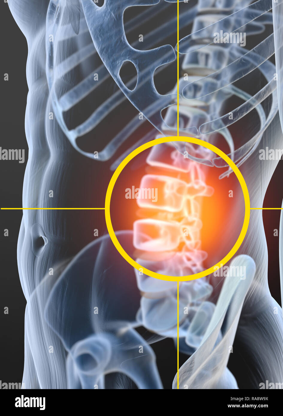 Arthrose der Wirbelsäule gemeinsame, Medizinisch 3D-Darstellung Stockfoto