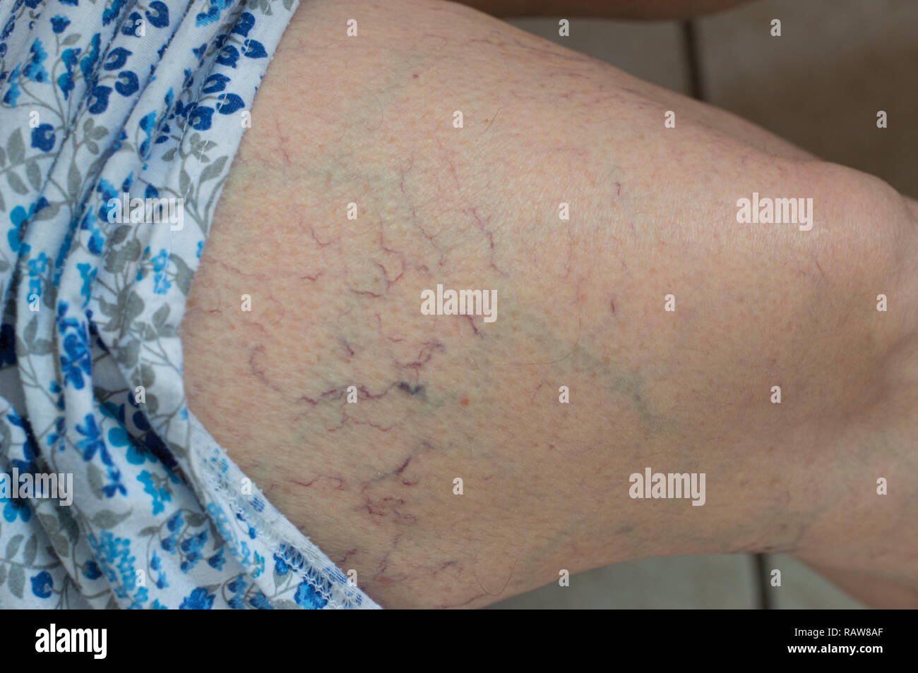 Varizen Besenreiser Am Bein Der Frau Stockfotografie Alamy