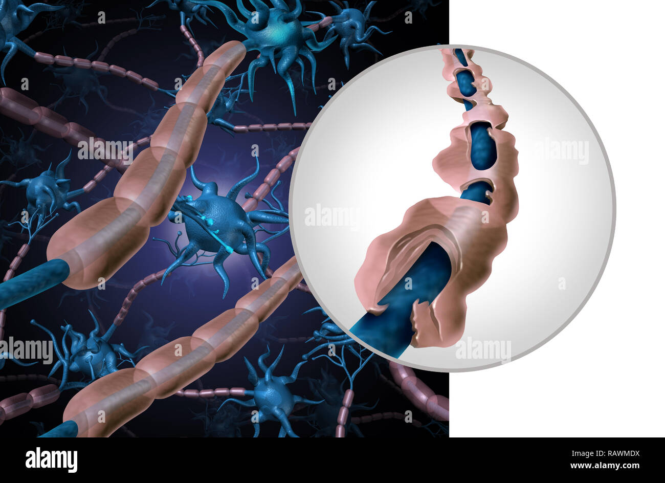 Multiple Sklerose myelin Krankheit oder MS autoimmune Störung mit gesunden Nerv mit freiliegender Faser mit scarrred Zelle Ummantelung Verlust. Stockfoto