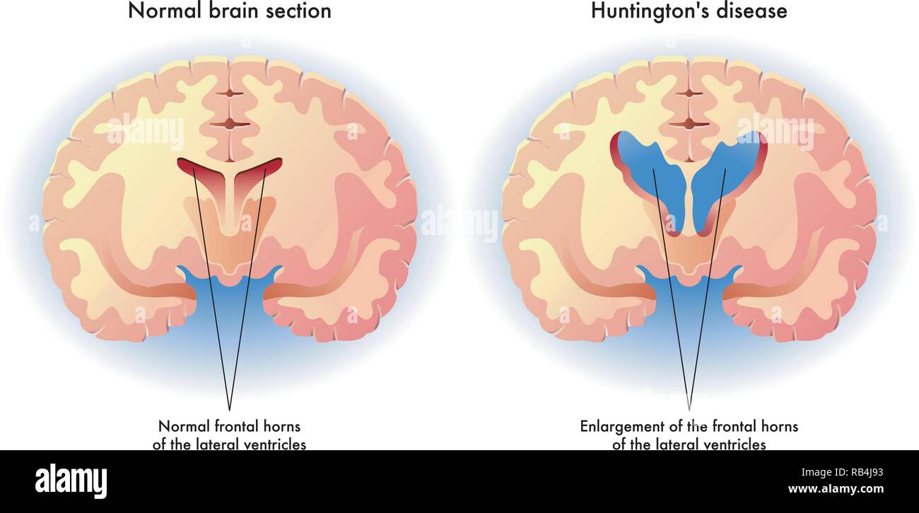 Medizinische Darstellung der Symptome der Huntington Krankheit im Gehirn Stock Vektor