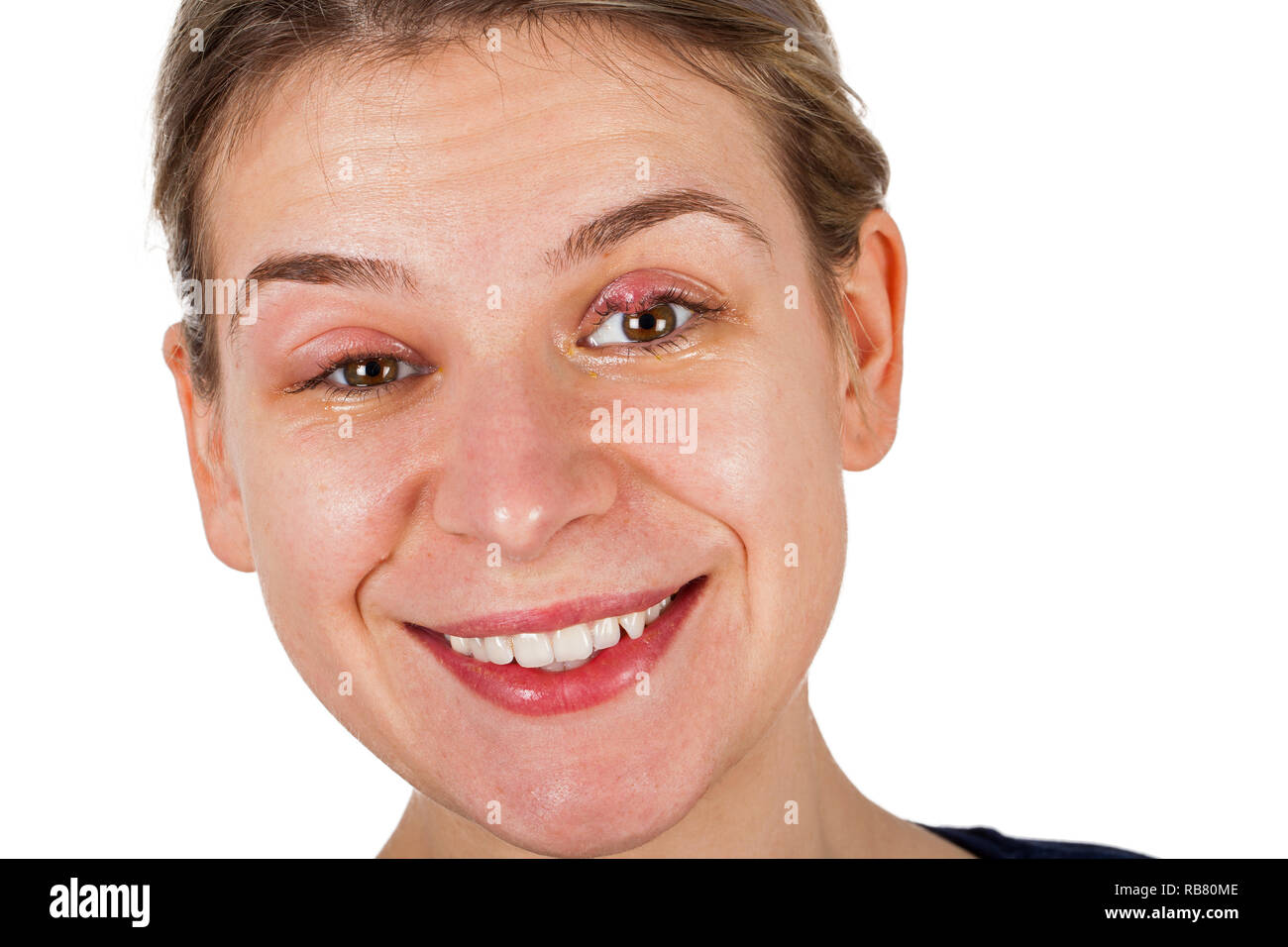 Geschwollenes augenlid -Fotos und -Bildmaterial in hoher Auflösung – Alamy