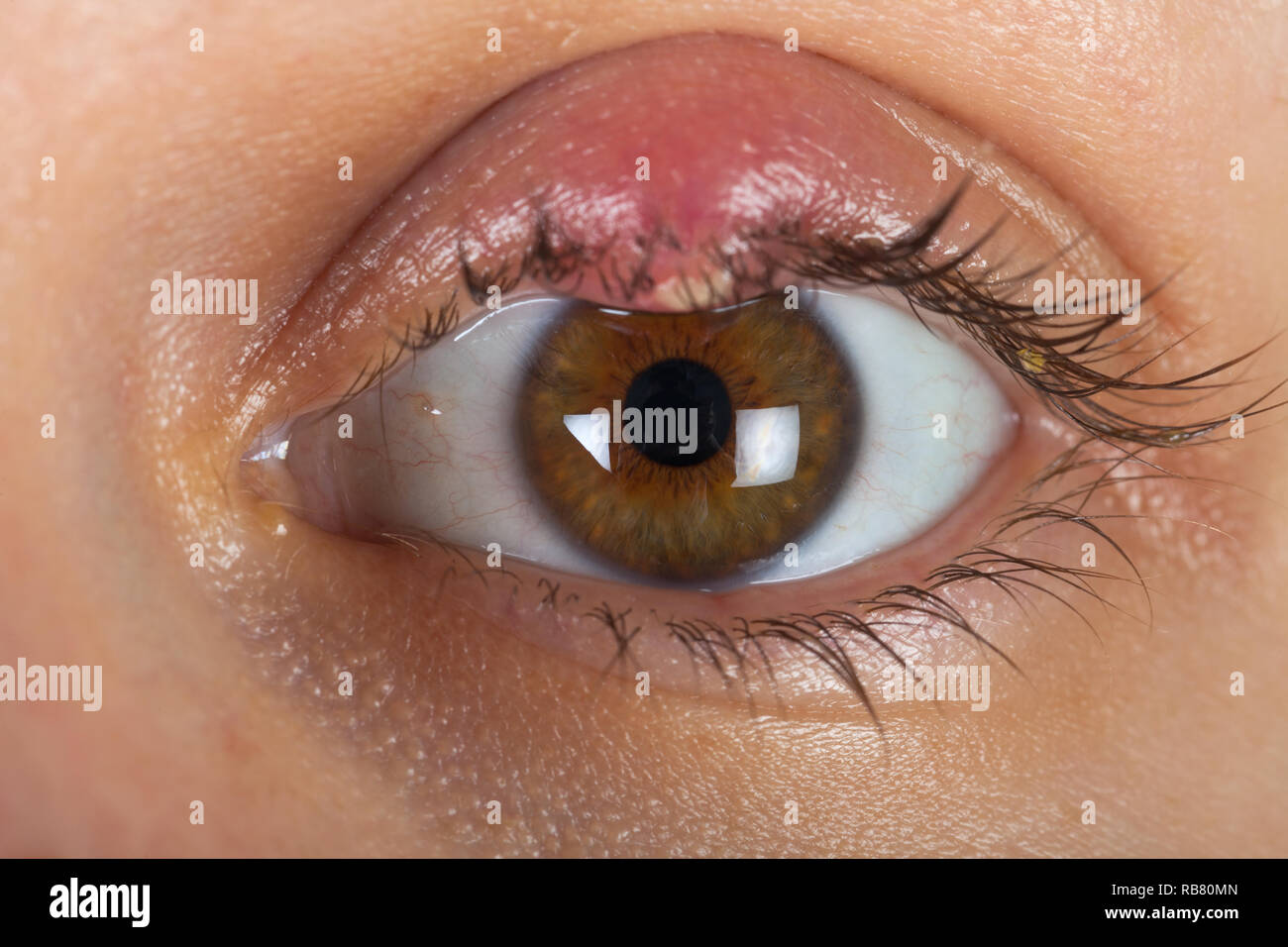 In der Nähe Bild von infizierten Auge des weiblichen Patienten. Hordeolum am oberen Augenlid. Virale Infektion. Staphylococcus Stockfoto