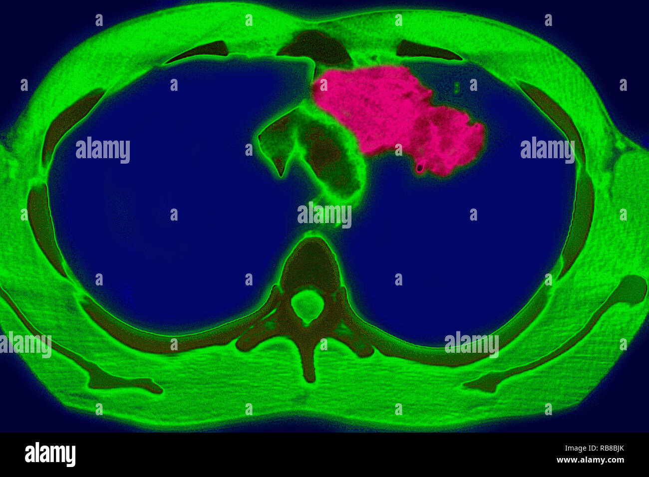 Lungentuberkulose, CT-Scan Stockfoto