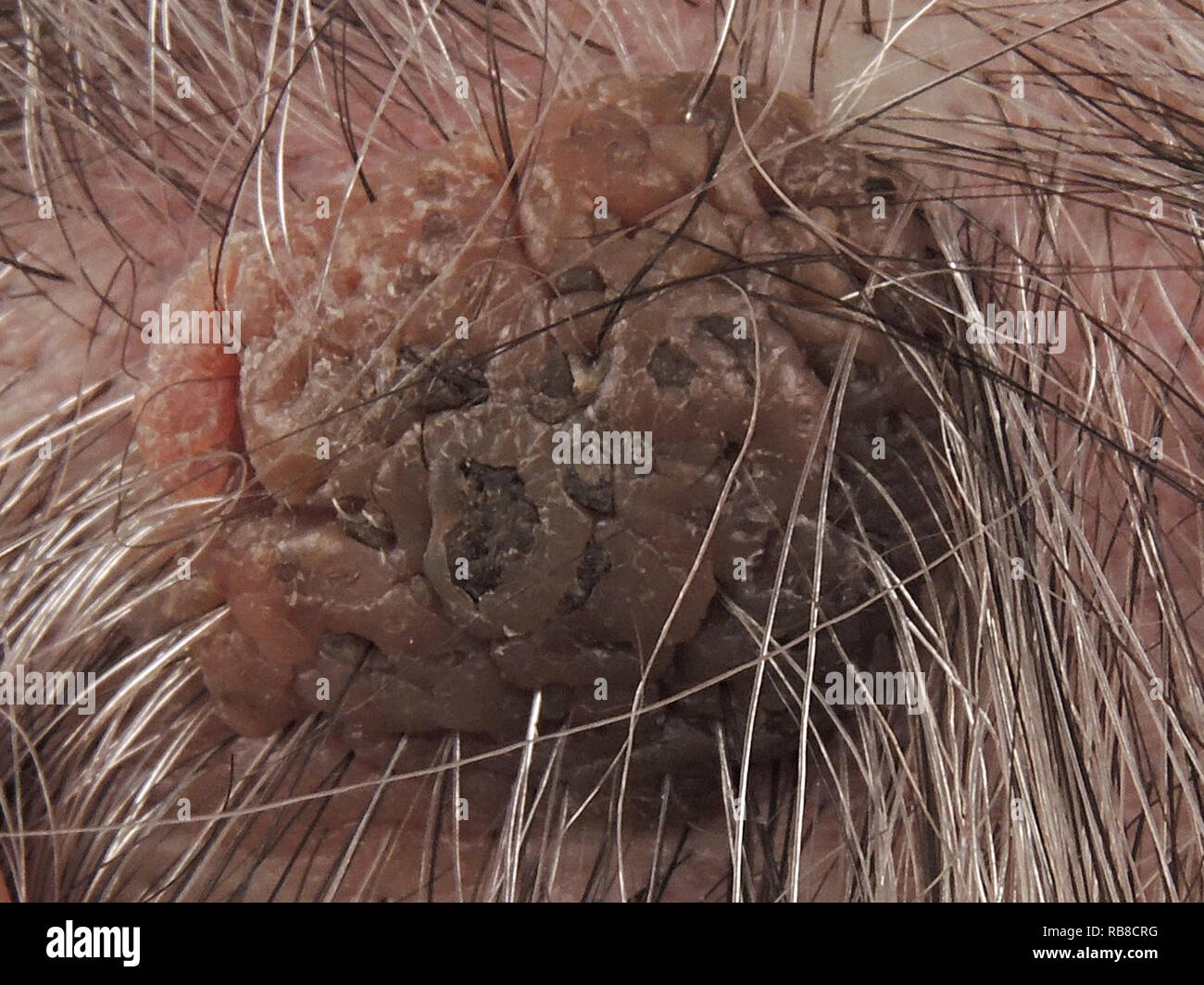 SEBORRHOISCHE KERATOSE Stockfoto