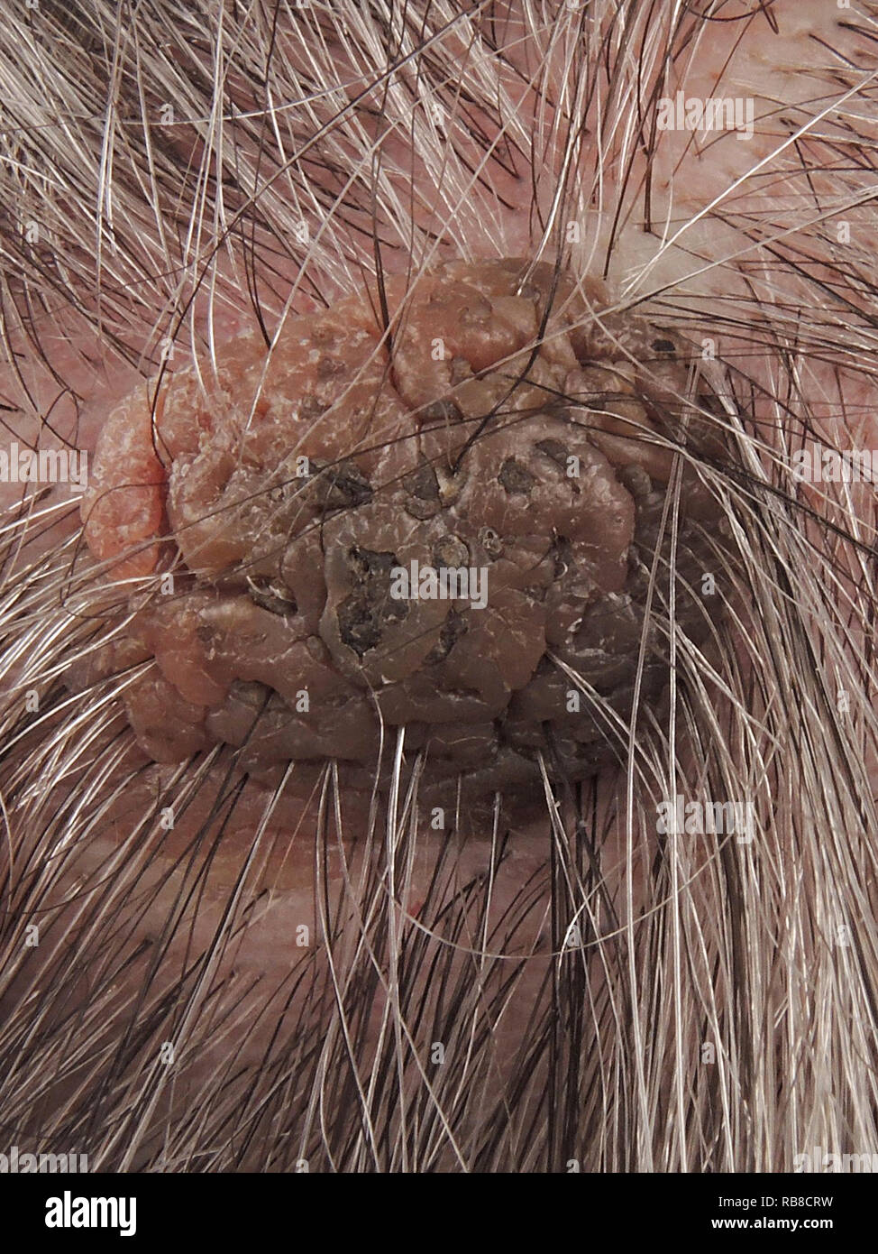 SEBORRHOISCHE KERATOSE Stockfoto