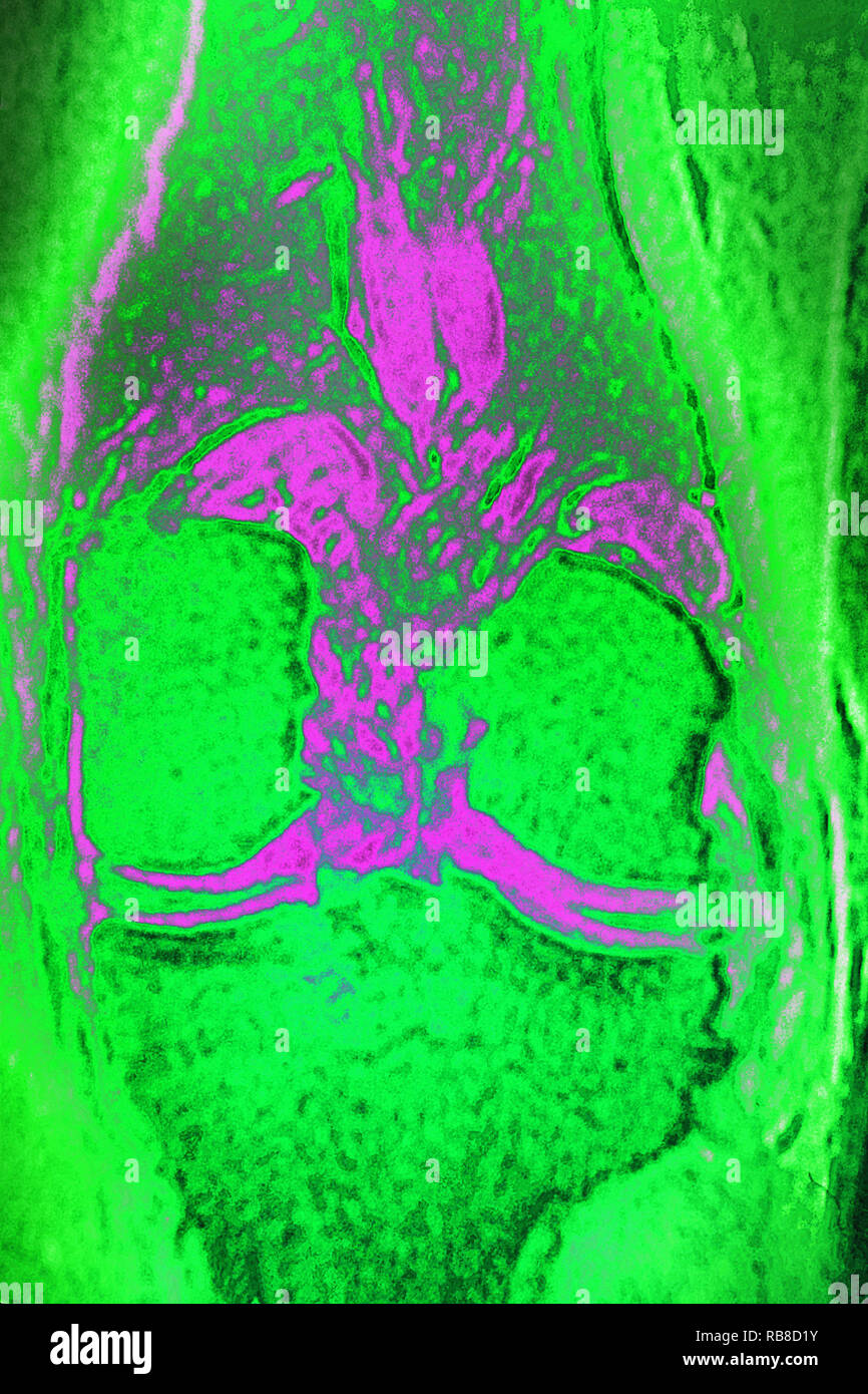Normale Knie MRI Stockfoto