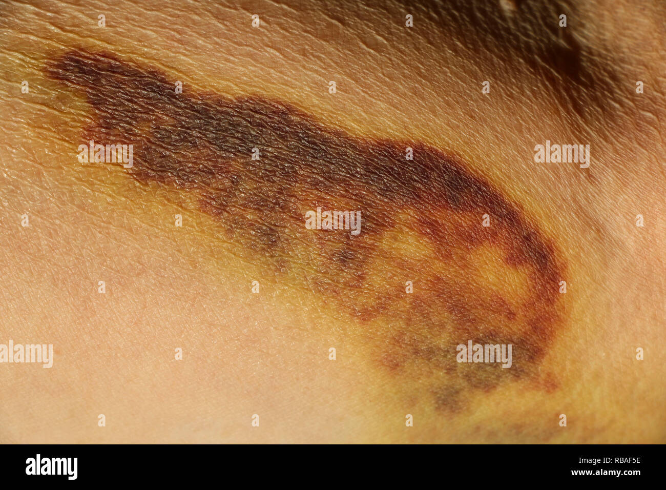 Auf die Haut der Hand einer alten Frau zertreten, Nahaufnahme Stockfoto