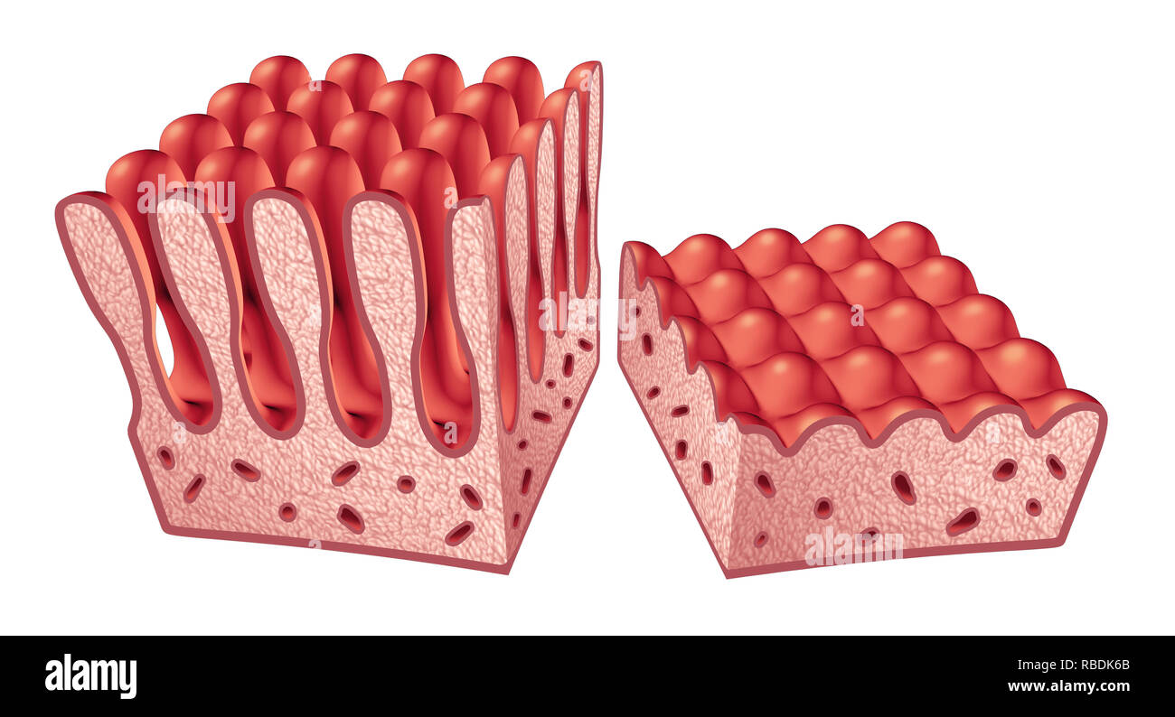 Zöliakie oder Zöliakie Anatomie medizinisches Konzept mit normalen Darmzotten und beschädigte Dünndarm Futter als eine autoimmune Störung der Verdauung. Stockfoto