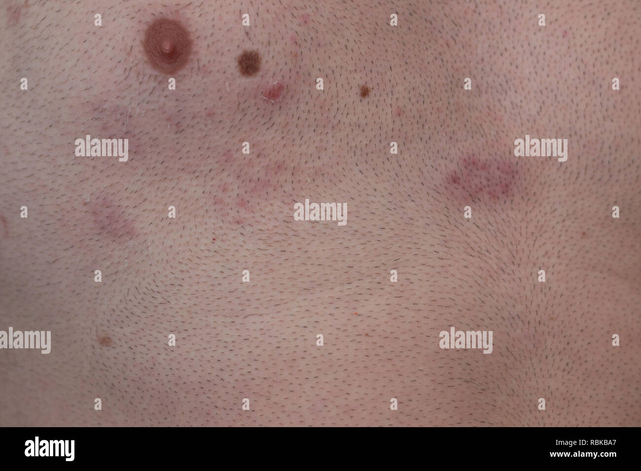 The illness herpes zoster -Fotos und -Bildmaterial in hoher Auflösung ...